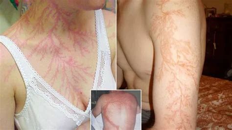 Incredible Photos Reveal What Happens To Your Skin If You Re Struck By