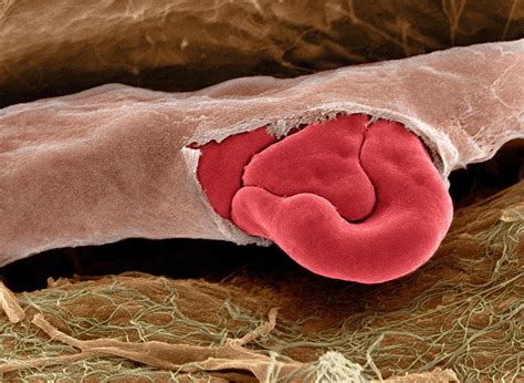 A ruptured capillary with red blood cells, seen at the electron ...