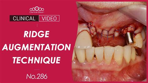 Ridge Augmentation Using Bone Tack Innooss B Dr Jeon Inseong Youtube