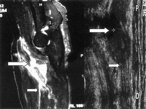 Torn Distal Biceps Tendon Longitudinal Ultrasound Image Right