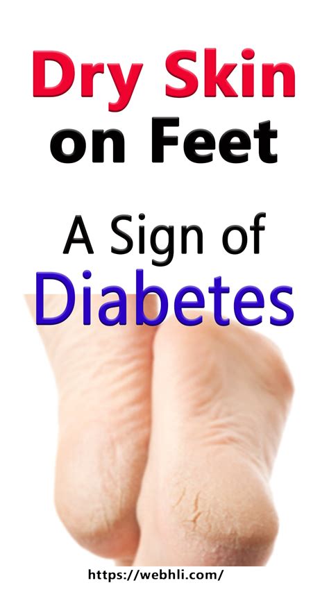 Dry Skin on Feet – A Sign of Diabetes | Healthy Lifestyle