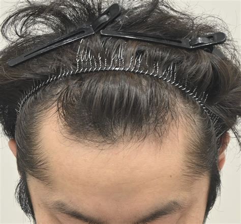 症例写真11640代後半男性aga治療薬の内服毛根再生注射ジェットメソ 髙倉慎也の『髪のたより』