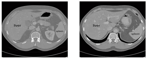 Sensors Free Full Text Liver Tumor Segmentation In Ct Scans Using Modified Segnet