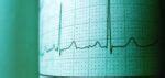 Heart Arrhythmia Irregular Heartbeat Causes Symptoms Diagnosis And