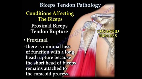 Biceps Tendon Pathology Everything You Need To Know Dr Nabil Ebraheim Youtube