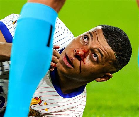 Euro Mbappe Suffers Broken Nose