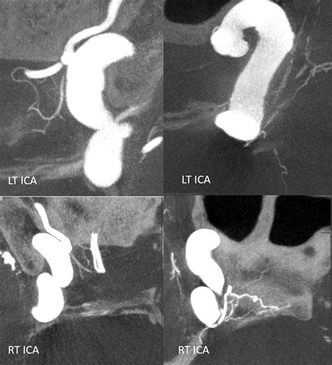 Superior Hypophyseal Artery