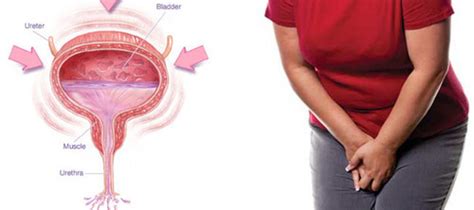 Learn About Overactive Bladder Advanced Medical Robotic Surgery