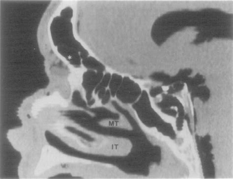 Head‐shake Vestibulo‐ocular Reflex Testing Comparison Of Results With