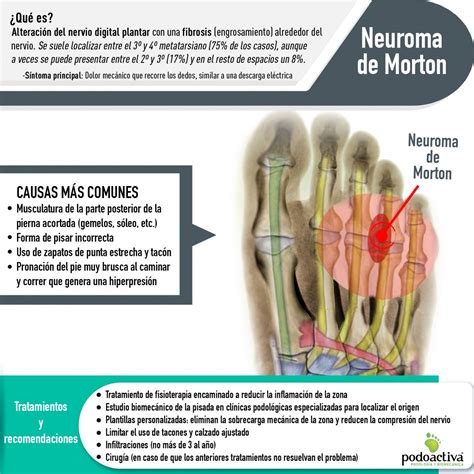 Qu Es El Neuroma De Morton S Ntomas Comunes Y Tratamiento