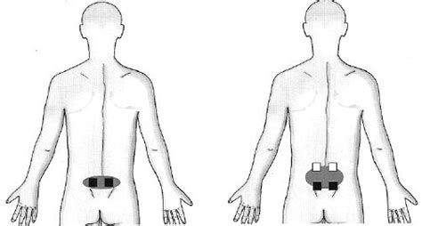 Tens Electrode Placement