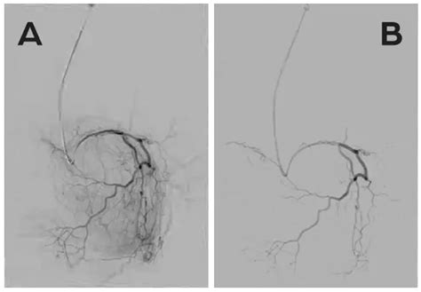 Genicular Artery Embolization Gae Radiology Of Indiana