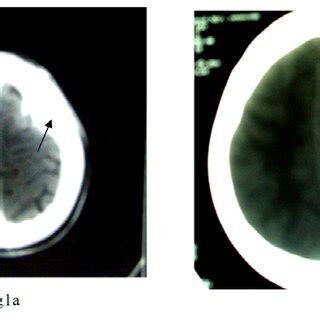 a. Axial CT image near the skull vertex showing hyperostosis of the ...