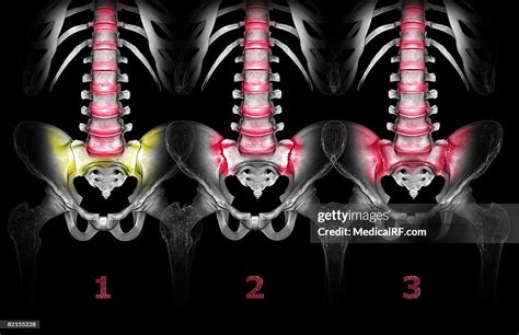 Pelvic Joint Pain High-Res Vector Graphic - Getty Images