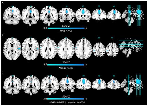 Brain Sciences Free Full Text Altered Spontaneous Brain Activity In