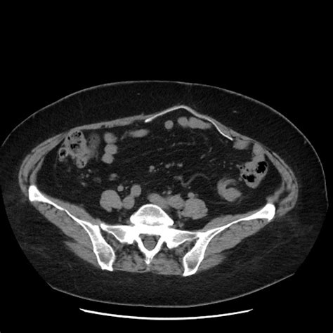 File Distal Colocolic Intussusception Due To Lipoma Epiploic