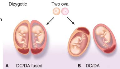 Chapter Multiple Gestations Flashcards Quizlet