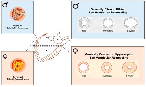 IJMS Free Full Text Sex Specific Features Of Calcific Aortic Valve Disease