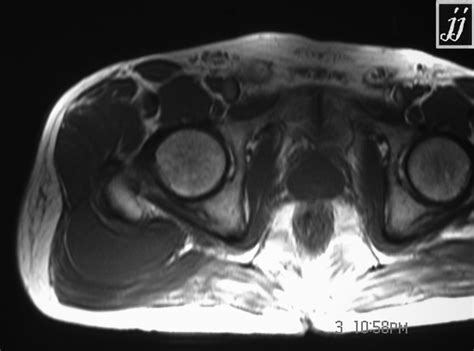 Right Gluteal Region Abscess Radiopaedia