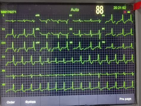 How to use ECG -Electrocardiograph Electrode Placement & Interpretation