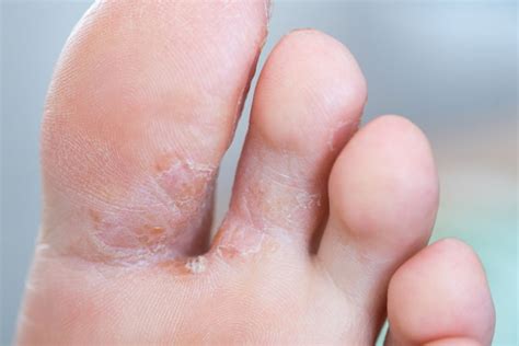 Pictures Of Fungal Infection On Foot Online Emergencydentistry