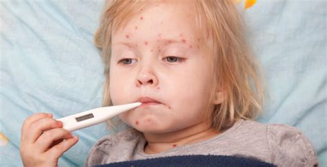 Chickenpox Vaccine Side Effects - National Vaccine Support Group