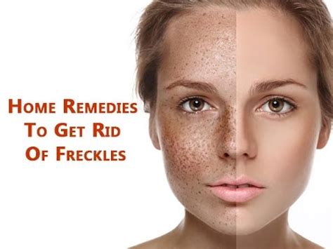 How To Get Rid Of Freckles Natural Ways To Remove Freckles Skin