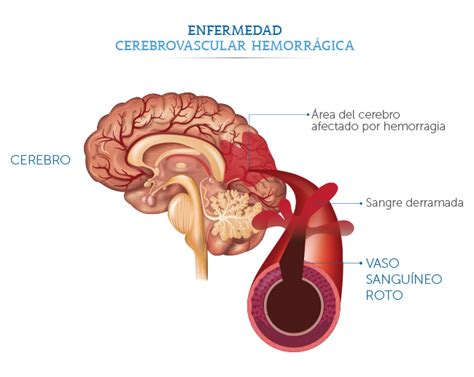 M Dica Sur Cl Nica De Enfermedad Cerebrovascular