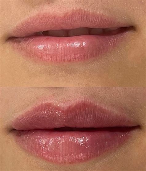 Best Natural Lip Fillers London Millicent Rose Skin