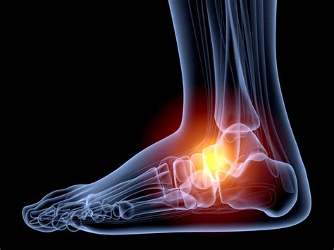 Causes Of Ankle Sprains Orthopedic Surgeon Lubbock Dr Kevin