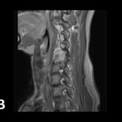 Pre And Postoperative Images AC Preoperative MRI In T1 Sequence With