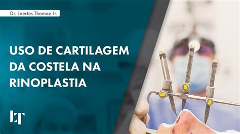 USO DE CARTILAGEM DA COSTELA NA RINOPLASTIA DR LAERTES THOMAZ JR