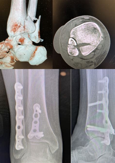 Fixation Of Posterior Malleolus Fractures: Literature Review And ...