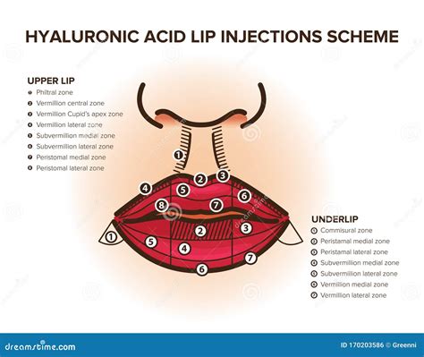 Lip Injections Hyaluronic Acid Filler Stock Vector Illustration Of