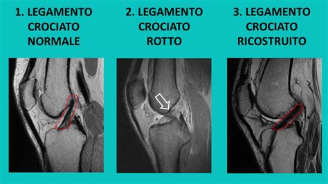 In Corso Psichiatria Ventilazione Legamento Crociato Anteriore Rotto