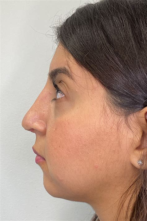 Before And After Gallery Best Rhinoplasty Los Angeles