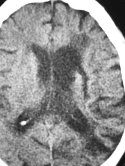 Slide Show Hypertensive Cerebral Hemorrhage