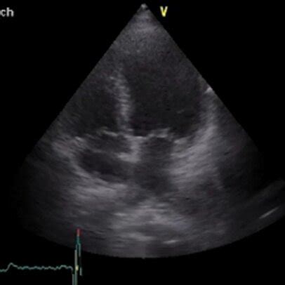 LAD coronary involvement during angiogram. | Download Scientific Diagram