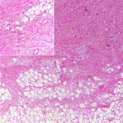 Photomicrograph Shows An Admixture Of Mature Adipose Tissue