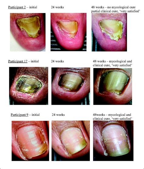 Vicks Vaporub To Treat Toenail Fungus Nail Ftempo