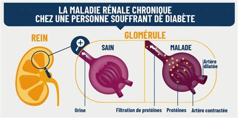 Diabète et maladie rénale chronique Maux Croisés