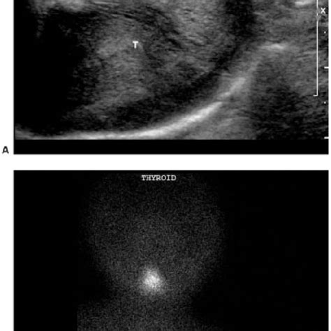 Pdf Sonography Of The Pediatric Thyroid A Pictorial Essay