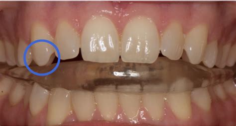 Splint For Anterior Open Bite Distortion Elizabeth Caughey