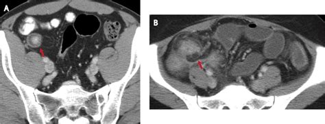 Large Intestine Gastrointestinal Pathology Pathology Achievable