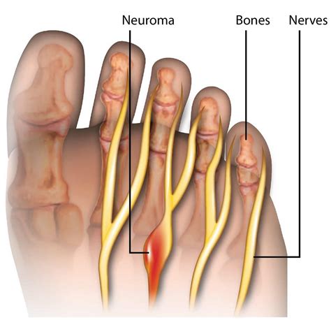 Riscos De Cirurgia De Neuroma De Morton Retoedu