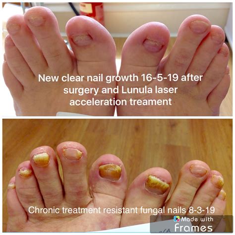 New Fungal Nail Treatments A Tailored Treatment Approach