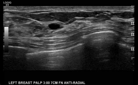 Figure Simple Cyst Of The Left Breast Contributed By Dawood Tafti