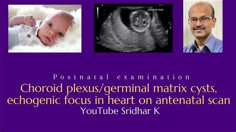 Choroid Plexus And Germinal Matrix Cyst Echogenic Focus In Fetal Heart