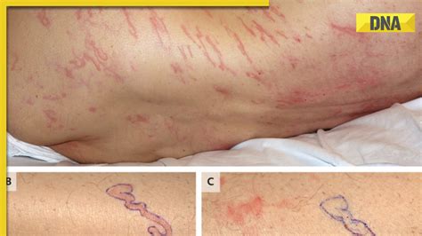 Man Discovers Roundworm Larvae Crawling Under His Skin Afflicted With
