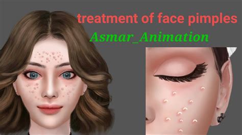 Asmr Acne Removal Skin Care Animation Full Blackhead Treatment Nose